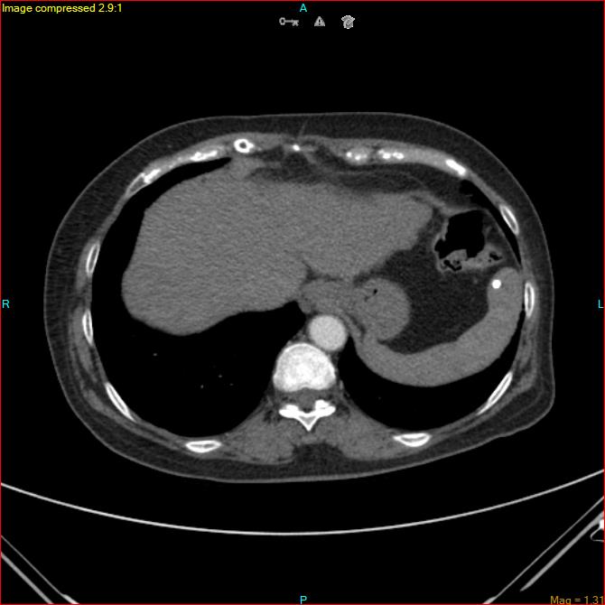 Azygos vein aneurysm (Radiopaedia 77824-90130 B 45).jpg