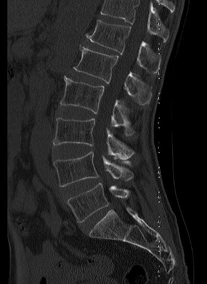 File:Baastrup syndrome (Radiopaedia 64891-73838 Sagittal bone window 12).jpg