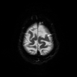 File:Balo concentric sclerosis (Radiopaedia 53875-59982 Axial DWI 47).jpg