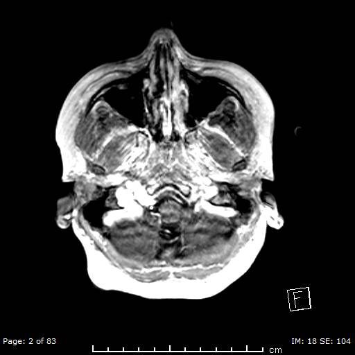 File:Balo concentric sclerosis (Radiopaedia 61637-69636 Axial T1 C+ 2).jpg
