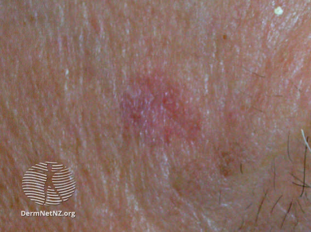 File:Basal cell carcinoma affecting the face (DermNet NZ lesions-bcc-face-0772).jpg