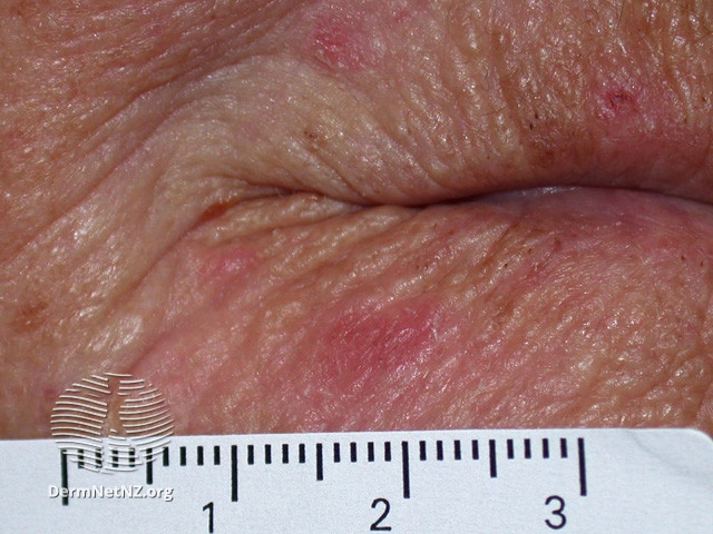 Basal cell carcinoma affecting the face (DermNet NZ lesions-bcc-face-1203).jpg