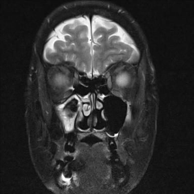 File:Base of skull chondrosarcoma (Radiopaedia 30410-31070 Coronal T2 fat sat 7).jpg