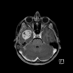 Base of skull rhabdomyosarcoma (Radiopaedia 32196-33142 T1 C+ fat sat 34).jpg