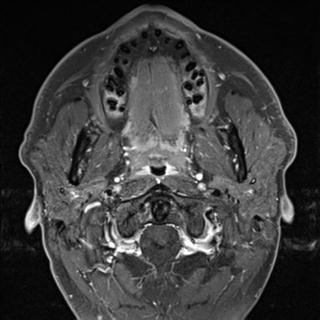 File:Base of tongue squamous cell carcinoma (Radiopaedia 31174-31884 Axial T1 C+ fat sat 28).jpg