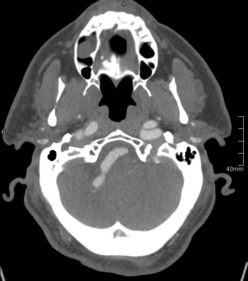 Basilar artery aneurysm (Radiopaedia 56261-62932 A 42).jpg