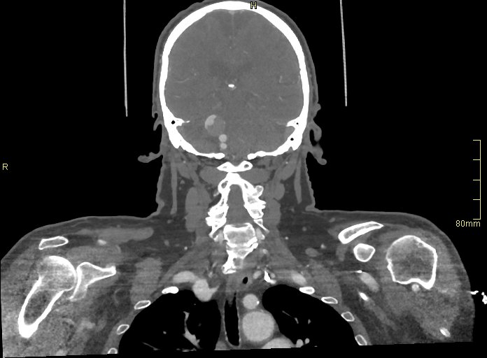 Basilar artery aneurysm (Radiopaedia 56261-62932 B 41).jpg
