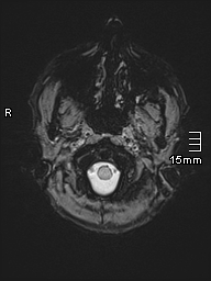Basilar artery perforator aneurysm (Radiopaedia 82455-99523 Axial SWI 2).jpg