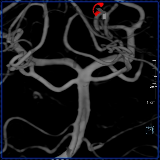 Basilar artery perforator aneurysm (Radiopaedia 82455-99524 3D Left VA 84).jpg