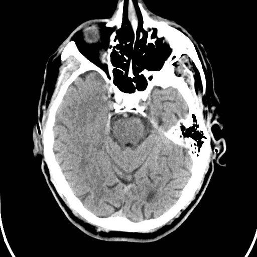 File:Basilar artery thrombosis (Radiopaedia 26986-27162 Axial non-contrast 11).jpg
