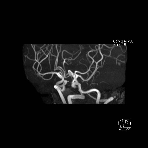 Basilar tip aneurysm (Radiopaedia 26504-26632 D 47).jpg
