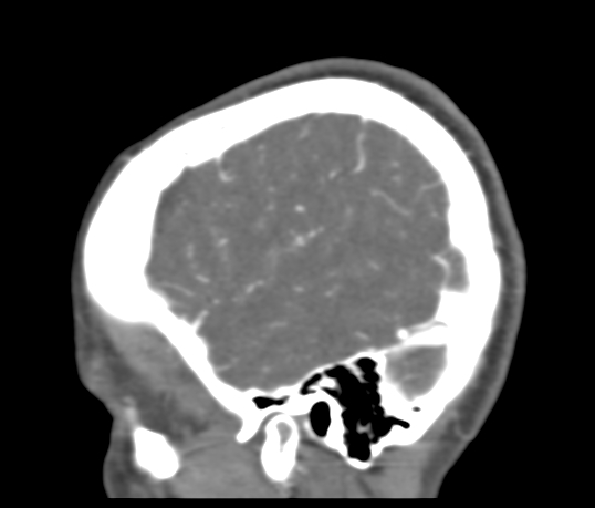 Basilar tip aneurysm with coiling (Radiopaedia 53912-60086 C 117).jpg