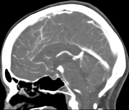Basilar tip aneurysm with coiling (Radiopaedia 53912-60086 C 67).jpg