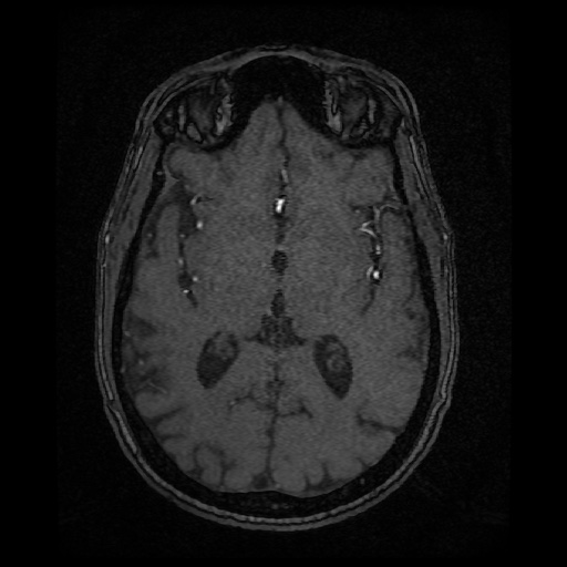 Basilar top and left middle cerebral artery aneurysm (Radiopaedia 61965-70031 Axial MRA 83).jpg