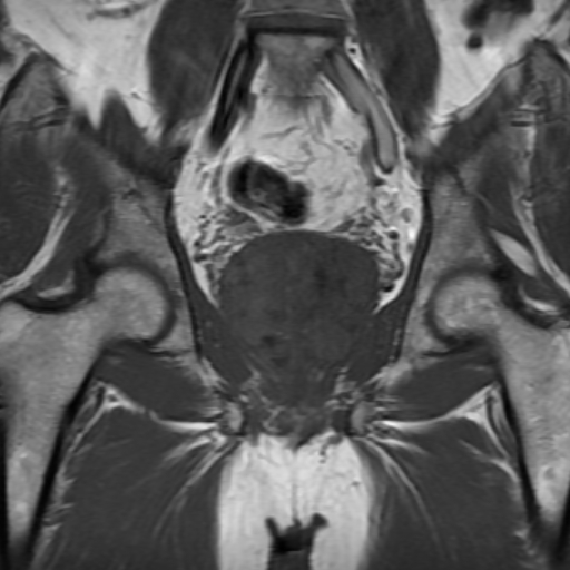 File:Benign prostatic nodular hyperplasia (Radiopaedia 16917-16634 Coronal T1 12).jpg