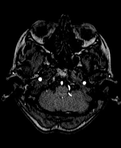 Berry aneurysm of the terminal internal carotid artery (Radiopaedia 88286-104918 Axial TOF 57).jpg