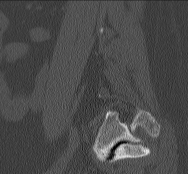 Bertolotti syndrome (Radiopaedia 24864-25128 Sagittal bone window 9).jpg