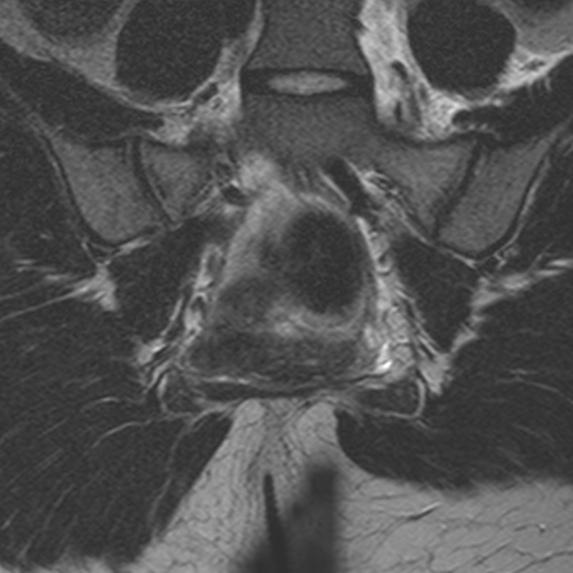 File:Bicornuate uterus (Radiopaedia 24677-24949 Coronal T2 18).jpg