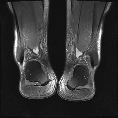 File:Bilateral Achilles tendon complete tear (Radiopaedia 81344-95051 Coronal PD fat sat 4).jpg