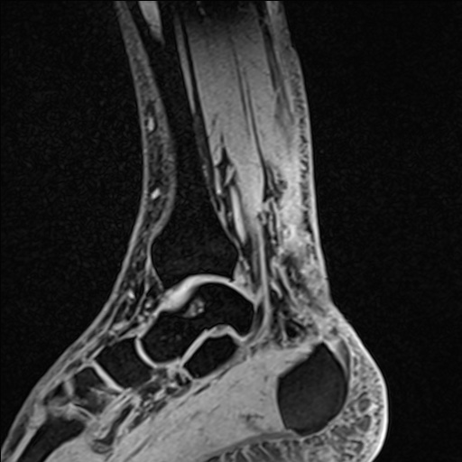 Bilateral Achilles tendon complete tear (Radiopaedia 81344-95051 Sagittal WE - Left 46).jpg