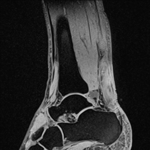Bilateral Achilles tendon complete tear (Radiopaedia 81344-95051 Sagittal WE - Right 50).jpg