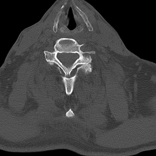 File:Bilateral C6-7 locked facet dislocation (Radiopaedia 28506-28748 Axial bone window 22).jpeg
