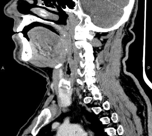 Bilateral Warthin tumors (Radiopaedia 84034-99263 D 47).jpg