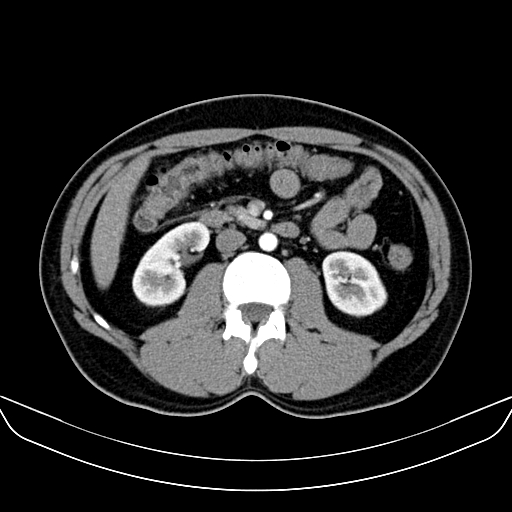 Bilateral accessory renal arteries with mild pelvi-ureteric junction (PUJ) obstruction (Radiopaedia 66357-75596 A 27).jpg