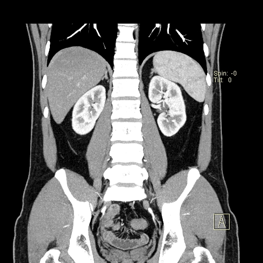 File:Bilateral accessory renal arteries with mild pelvi-ureteric junction (PUJ) obstruction (Radiopaedia 66357-75596 B 36).jpg