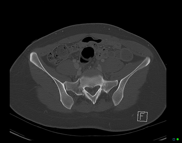 File:Bilateral acetabular fractures (Radiopaedia 79272-92308 Axial bone window 16).jpg