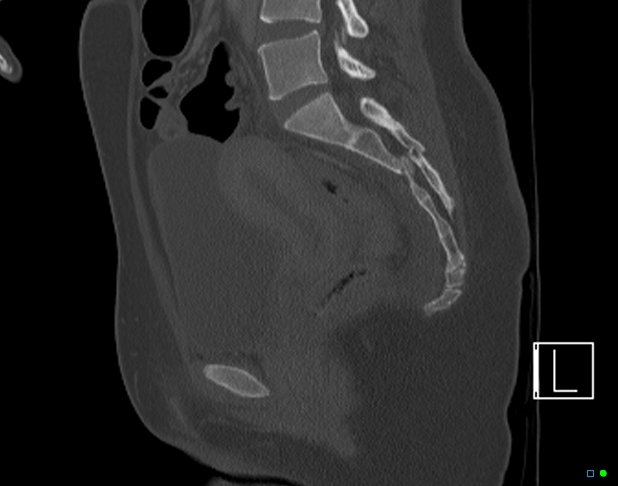 Bilateral acetabular fractures (Radiopaedia 79272-92308 Sagittal bone window 45).jpg