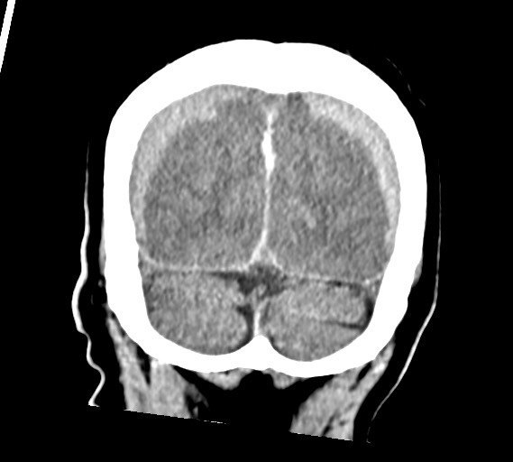 Bilateral acute on chronic subdural hematomas (Radiopaedia 78466-91146 Coronal non-contrast 57).jpg