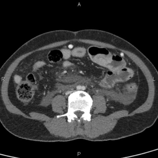 Bilateral adrenal gland hyperenhancement in pancreatitis (Radiopaedia 86642-102753 E 69).jpg