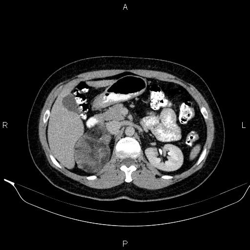 Bilateral adrenal myelolipoma (Radiopaedia 63058-71535 Axial C+ delayed 37).jpg