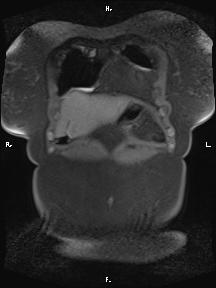 Bilateral adrenal myelolipoma (Radiopaedia 63058-71537 Coronal T1 fat sat 96).jpg