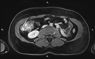 File:Bilateral adrenal myelolipoma (Radiopaedia 63058-71537 H 63).jpg
