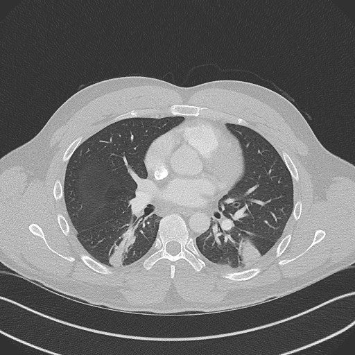 Bilateral atelectasis (Radiopaedia 48666-53675 Axial lung window 58).jpg