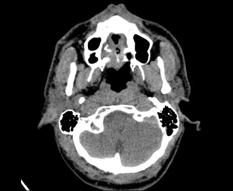 Bilateral carotid body tumors (Radiopaedia 61841-69870 Axial non-contrast 12).jpg