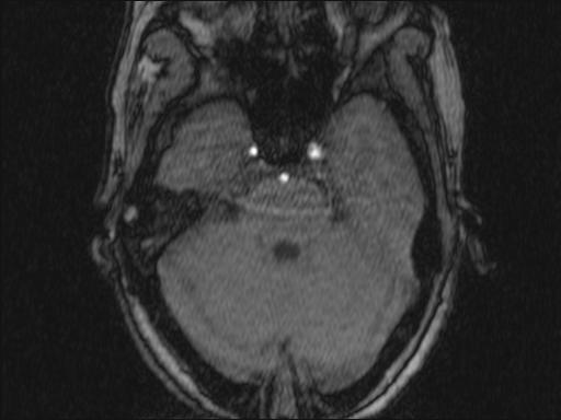 Bilateral carotid body tumors and right glomus jugulare tumor (Radiopaedia 20024-20060 Axial MRA 325).jpg