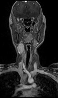 Bilateral carotid body tumors and right glomus jugulare tumor (Radiopaedia 20024-20060 MRA 13).jpg