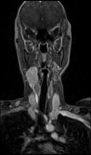 Bilateral carotid body tumors and right glomus jugulare tumor (Radiopaedia 20024-20060 MRA 17).jpg