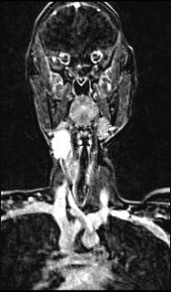 Bilateral carotid body tumors and right glomus jugulare tumor (Radiopaedia 20024-20060 MRA 84).jpg