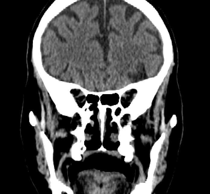 Bilateral ectopia lentis (Radiopaedia 89889-107013 Coronal non-contrast 94).jpg