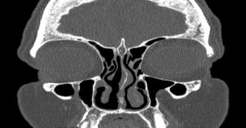 File:Bilateral ectopic infraorbital nerves (Radiopaedia 49006-54084 Coronal 53).png