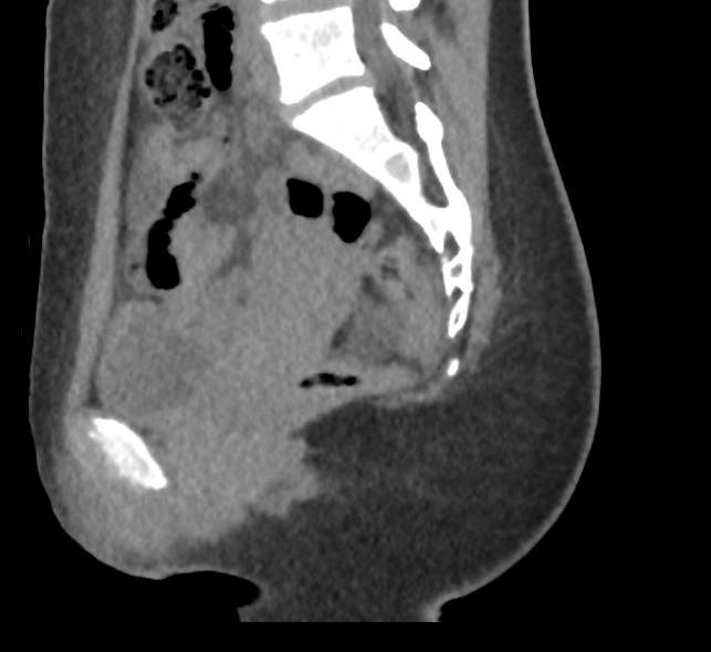 Bilateral mature cystic ovarian teratoma (Radiopaedia 88821-105592 D 28).jpg