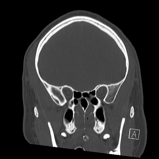 Bilateral occipital condyle fracture (type 2) (Radiopaedia 87675-104089 Coronal bone window 31).jpg