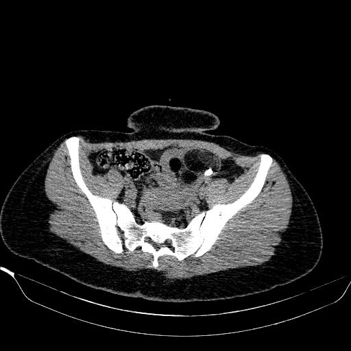 File:Bilateral ovarian dermoid (Radiopaedia 45714-49907 Axial non-contrast 17).JPEG
