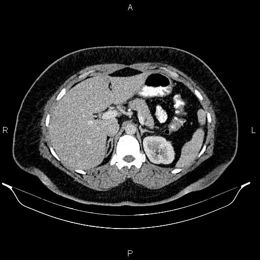 Bilateral ovarian dermoid cysts (Radiopaedia 85785-101603 A 33).jpg