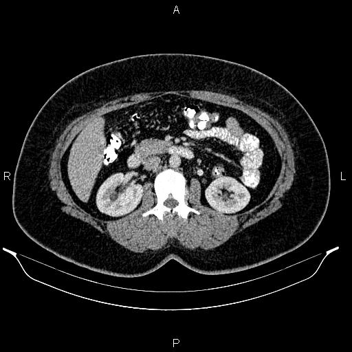 Bilateral ovarian dermoid cysts (Radiopaedia 85785-101603 A 48).jpg