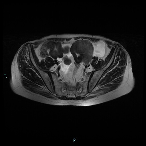 File:Bilateral ovarian fibroma (Radiopaedia 44568-48293 Axial T2 9).jpg